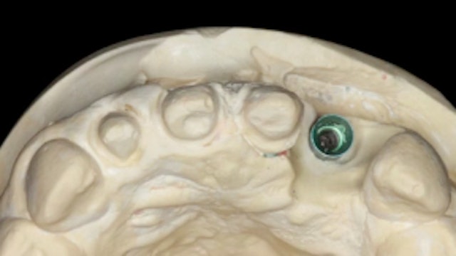 Pre-designing implant abutments in the esthetic zone following biological width