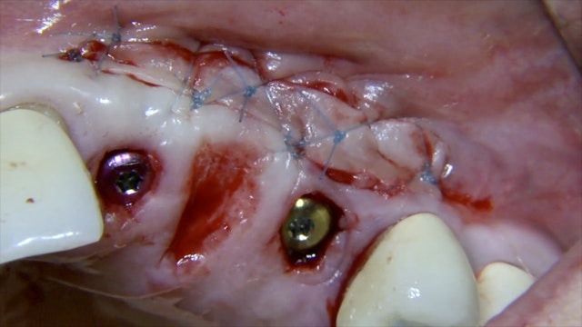 CLINICAL VIDEO Increasing keratinized gingiva around upper implants using a 