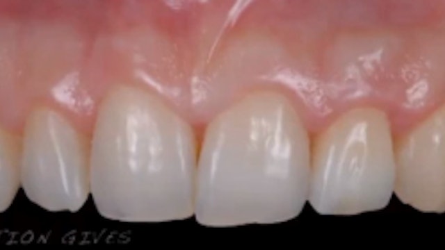 Immediate Tooth Replacement: Review, Articles, and Cases