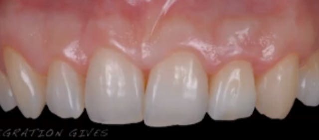 Immediate Tooth Replacement: Review, ...