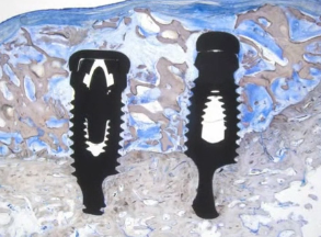 Ridge Augmentation Using rhPDGF Growth Factors