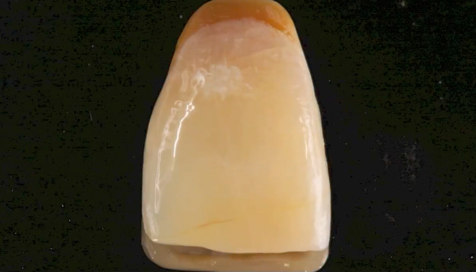 CLINICAL VIDEO Immediate Implant Placement in the Esthetic Zone- Dr Robert Silva