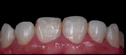 Color en Odontología - Comunicación con el Laboratorio (SPANISH)