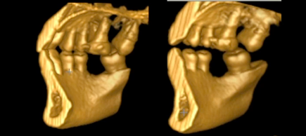 Lasers in Contemporary Implant Dentistry - Part 1
