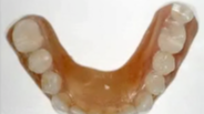Treatment Planning and Prosthetic Procedures for Removable Implant Overdentures