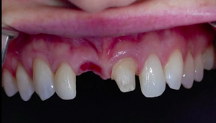 Avoiding Pitfalls with Guided Bone Regeneration