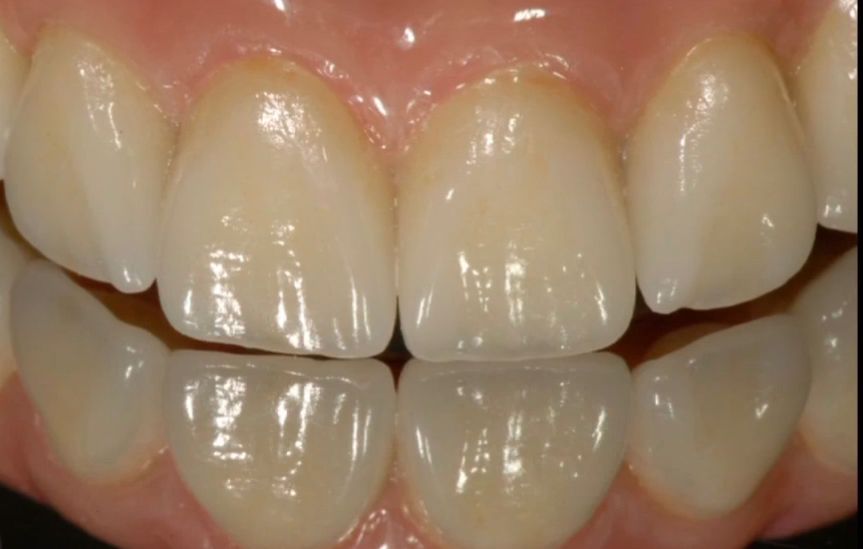 The 7 essential keys to success in Aesthetic Implant Restorations