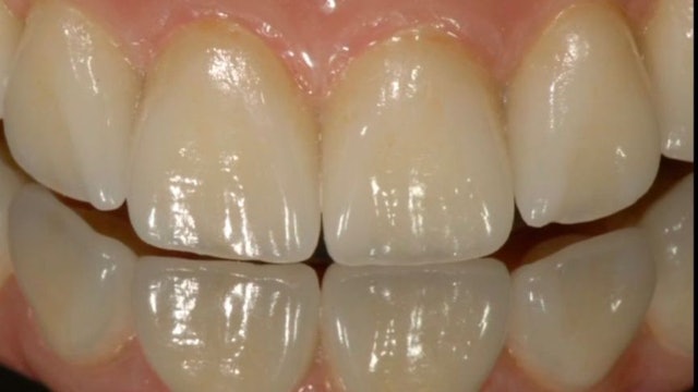 The 7 essential keys to success in Aesthetic Implant Restorations