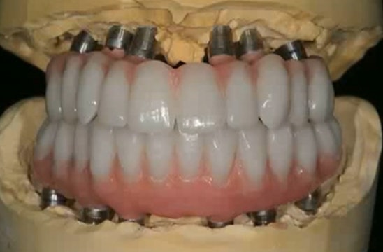 New Advances in Esthetic Implant Dentistry: Results with different Implant desi