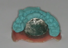 Treating the Edentulous Arch with Removable Implant Overdentures - Denture Conv