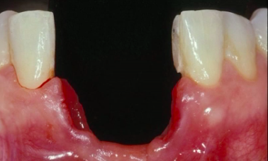 CLINICAL VIDEO The treatment of an anterior lower severely resorbed ridge with V