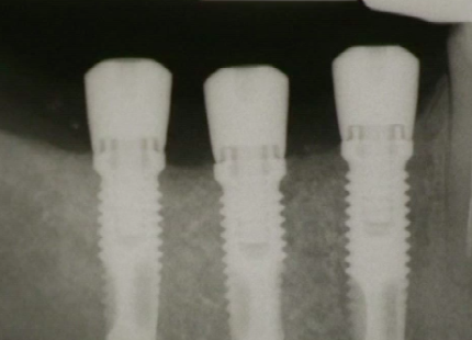 CLINICAL VIDEO Horizontal Augmentation Using Particulated Composite Bone Graft a