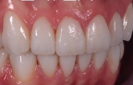 Modern Approach to Tooth Preparation: Full Enamel Concept | Dr Giacomo Fabbri