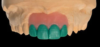 Hard & Soft Tissue Augmentation using GBR | Dr Jovanovic