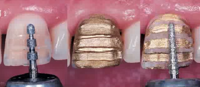 Porcelain Laminate Veneers: Predictable Tooth Preparation for Complex Cases (TU