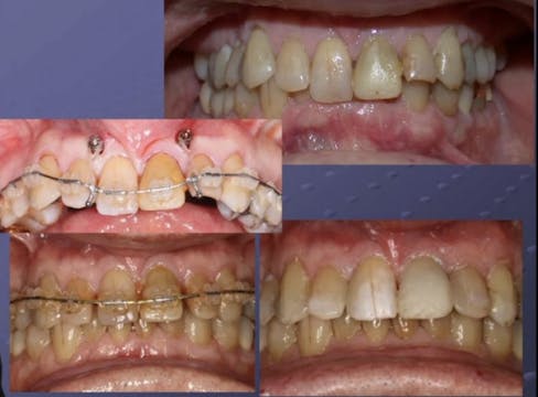 Implant-Assisted Orthodontics: Moving...