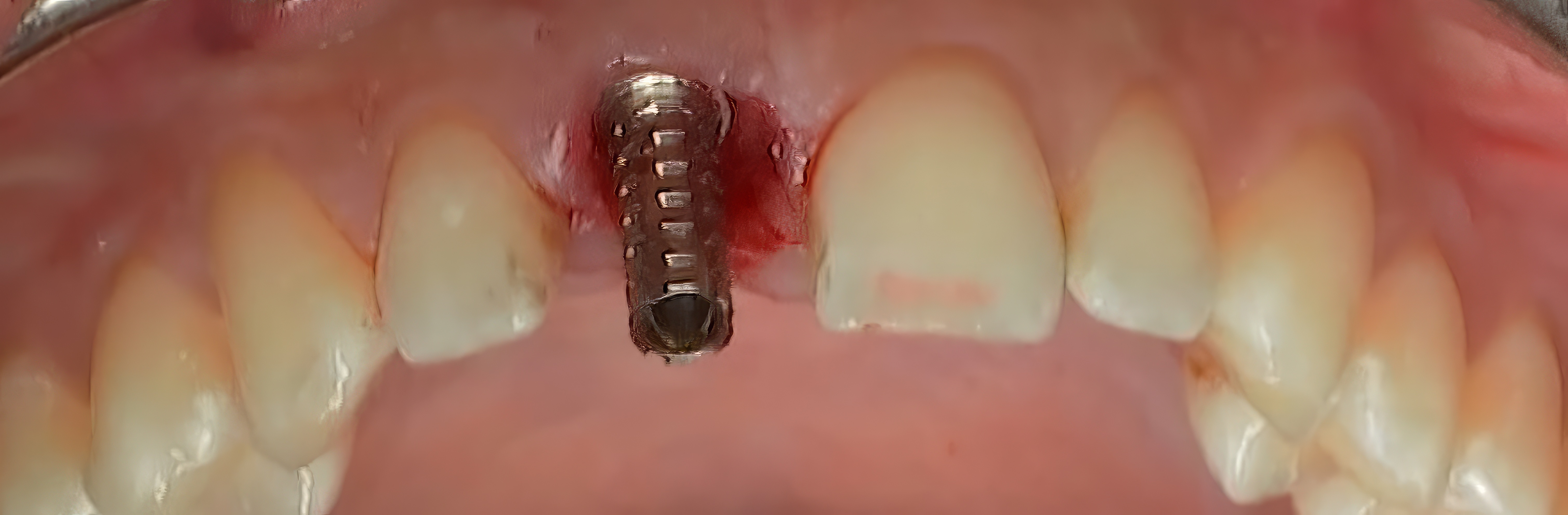 CLINICAL VIDEO Immediate tooth replacement with implant placement and temporiza 