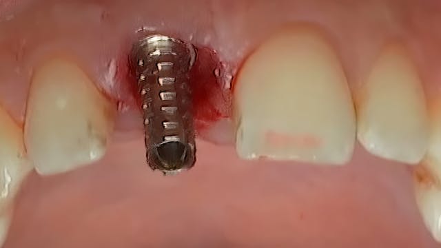CLINICAL VIDEO Immediate tooth replac...