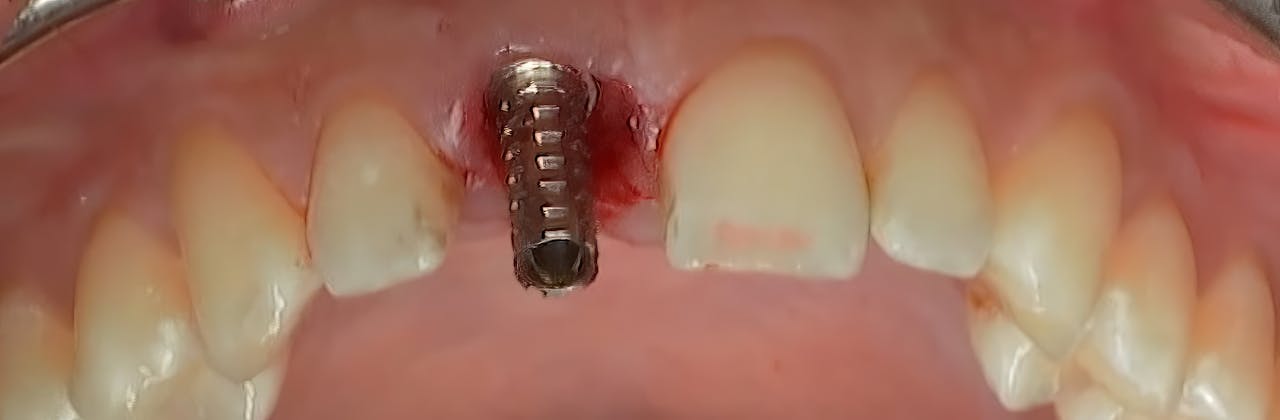 CLINICAL VIDEO Immediate tooth replacement with implant placement and