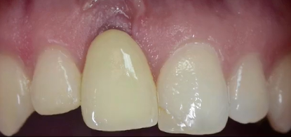 Esthetic Failure Around Osteointegrated Implants | Dr Zucchelli
