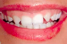 Periodontal Plastic Surgery for Enhanced Esthetic Outcomes (THAI LANGUAGE ONLY)