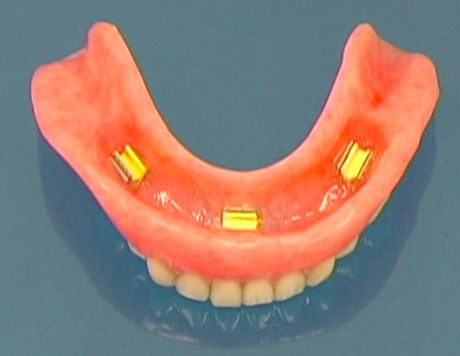 CLINICAL VIDEO Treatment of the Edentulous Lower Jaw with 4 Dental Implants for 