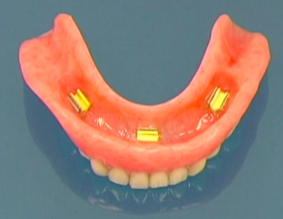 CLINICAL VIDEO Treatment of the Edentulous Lower Jaw with 4 Dental