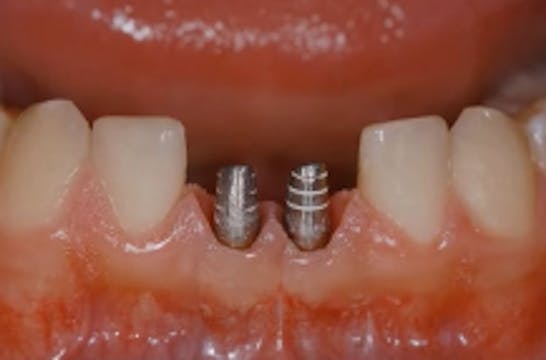 Restoring the Small Gap Using Implants