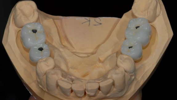 A-Z in Restorative Implant Dentistry (Part 4) - Basic Restorative Theory: The r