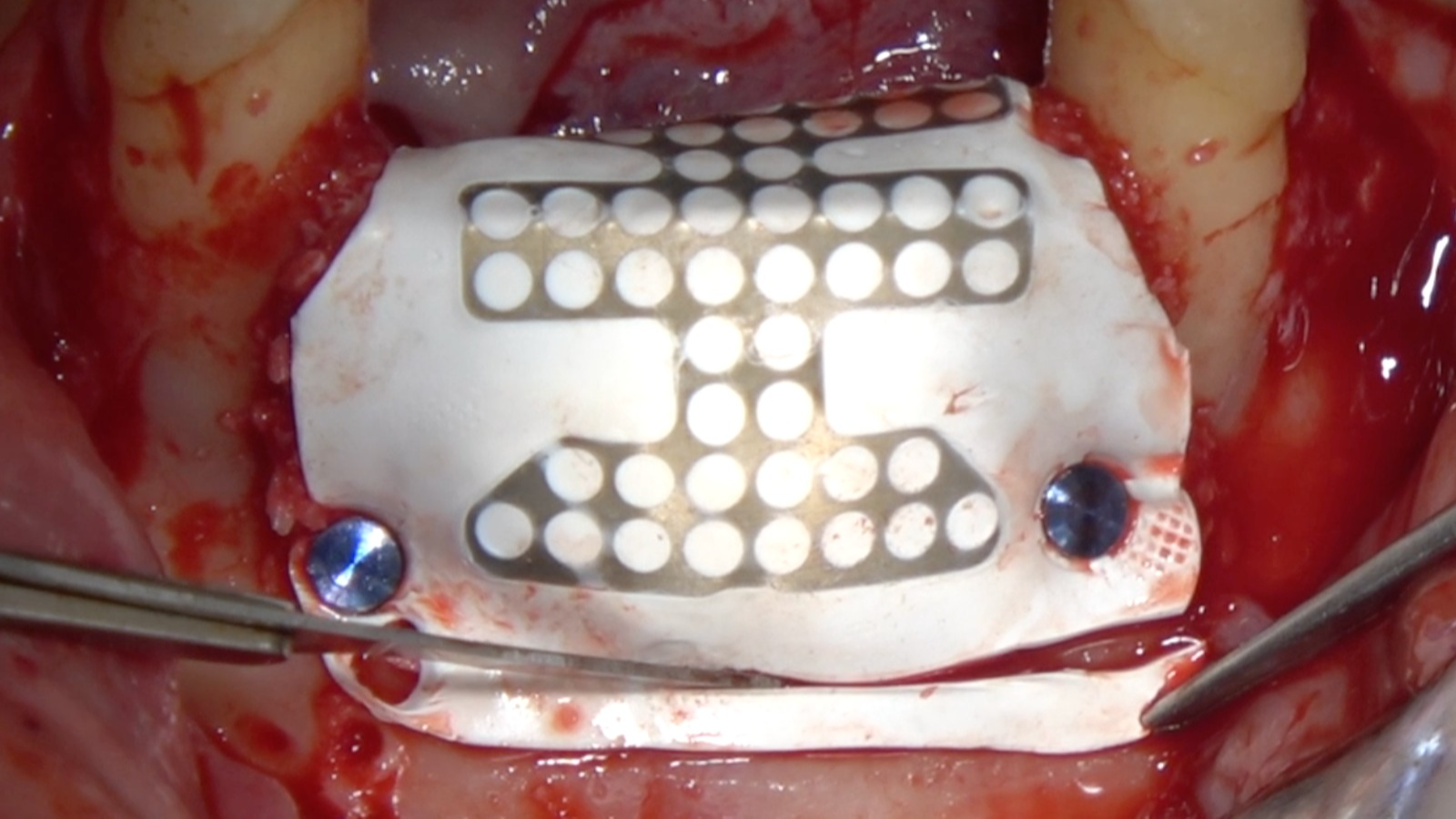 CLINICAL VIDEO Vertical & Horizontal GBR Ridge Augmentation of a Severe Lower An