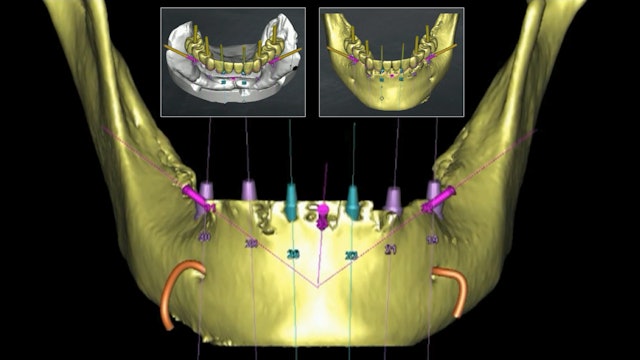 The Complete Digital Workflow - Part 1: Airway Focused Dentistry