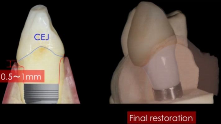 Guidelines for Aesthetic Peri-Implant Gingival Tissue (JAPANESE LANGUAGE ONLY)