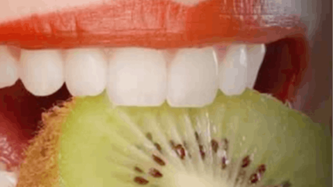 Vital Bleaching gIDE Dental Institute