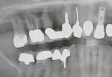 CLINICAL VIDEO Vertical Ridge Augmentation in the Posterior Mandible using rhBM