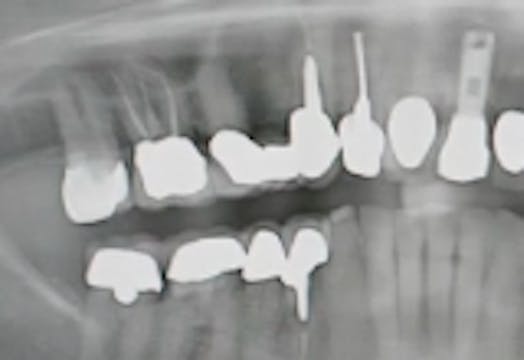 CLINICAL VIDEO Vertical Ridge Augment...