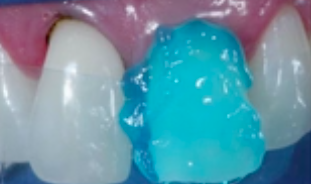 Adhesive & Esthetic Dentistry - Minimally Invasive Procedures (Part 2 of 4)