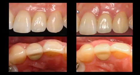 Soft Tissue Grafting for Implant Complications in the Esthetic Zone| Dr Paul Lin