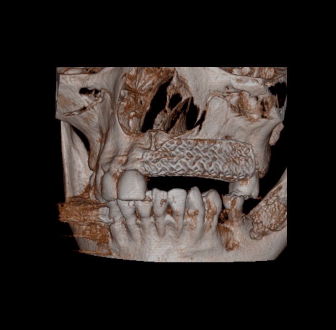 CLINICAL VIDEO Custom 3D Titanium Mesh for Guided Bone Regeneration in a Severel
