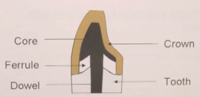 Functional Crown Lengthening for More Predictable Restorative