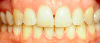 Periodontal Plastic Surgery for Natural Teeth and Implants