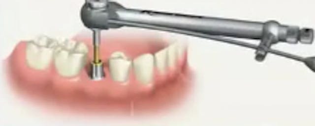 Posterior Implant Placement from a Re...