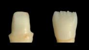 Which Ceramic Should I Use? A Clinical Perspective - Part 2