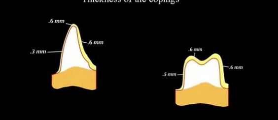 All Ceramic Restoration (JAPANESE LANGUAGE ONLY)