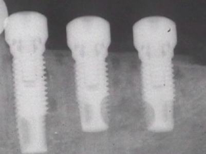 CLINICAL VIDEO Staged treatment of a thin posterior mandibular ridge with block 