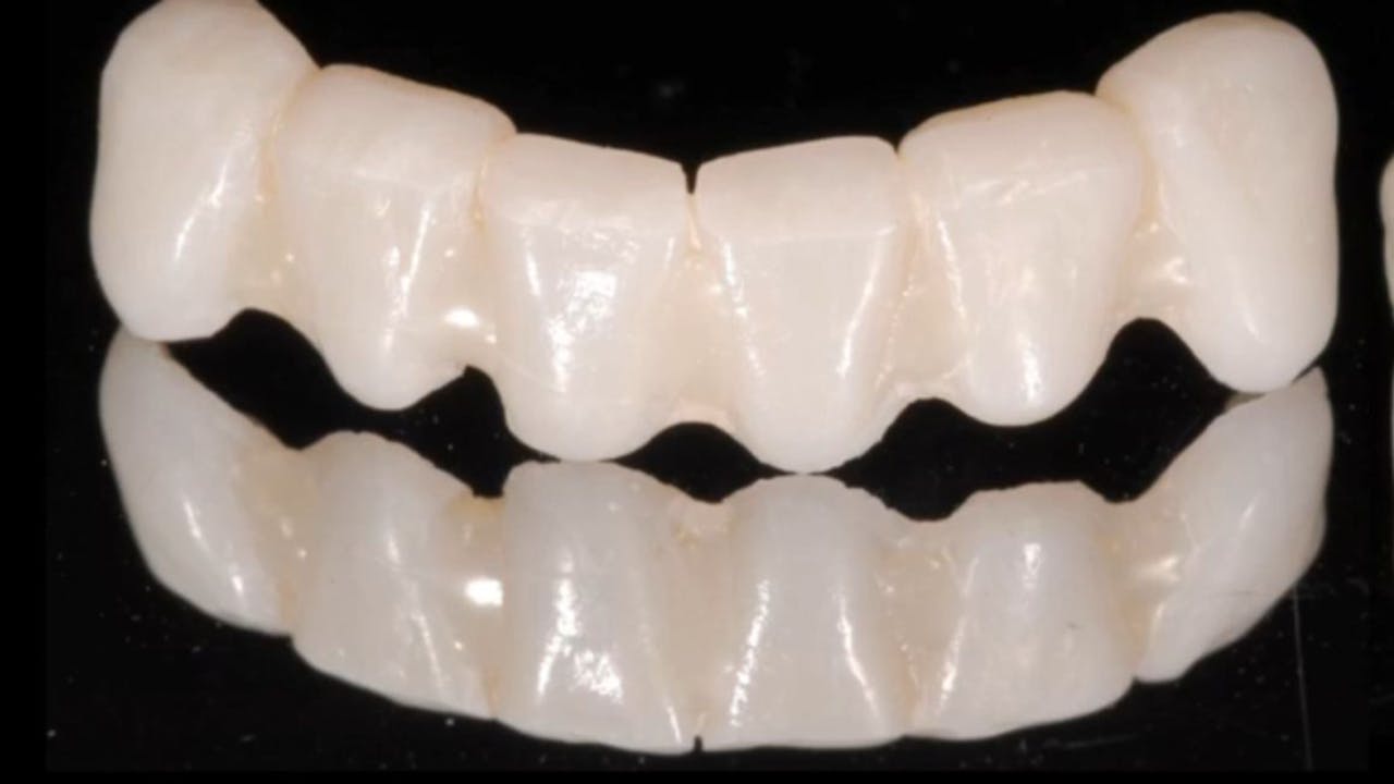 Provisional Restoration The Overlooked Link to Aesthetic and Functional Perfe gIDE Dental