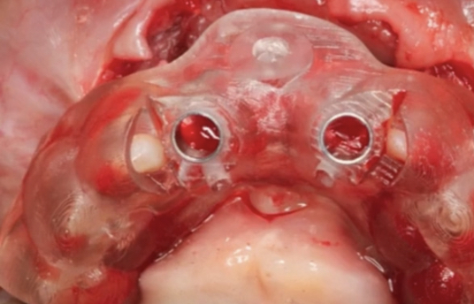 Staged ridge augmentation using GBR with a TR-PTFE membrane in a thin anterior m