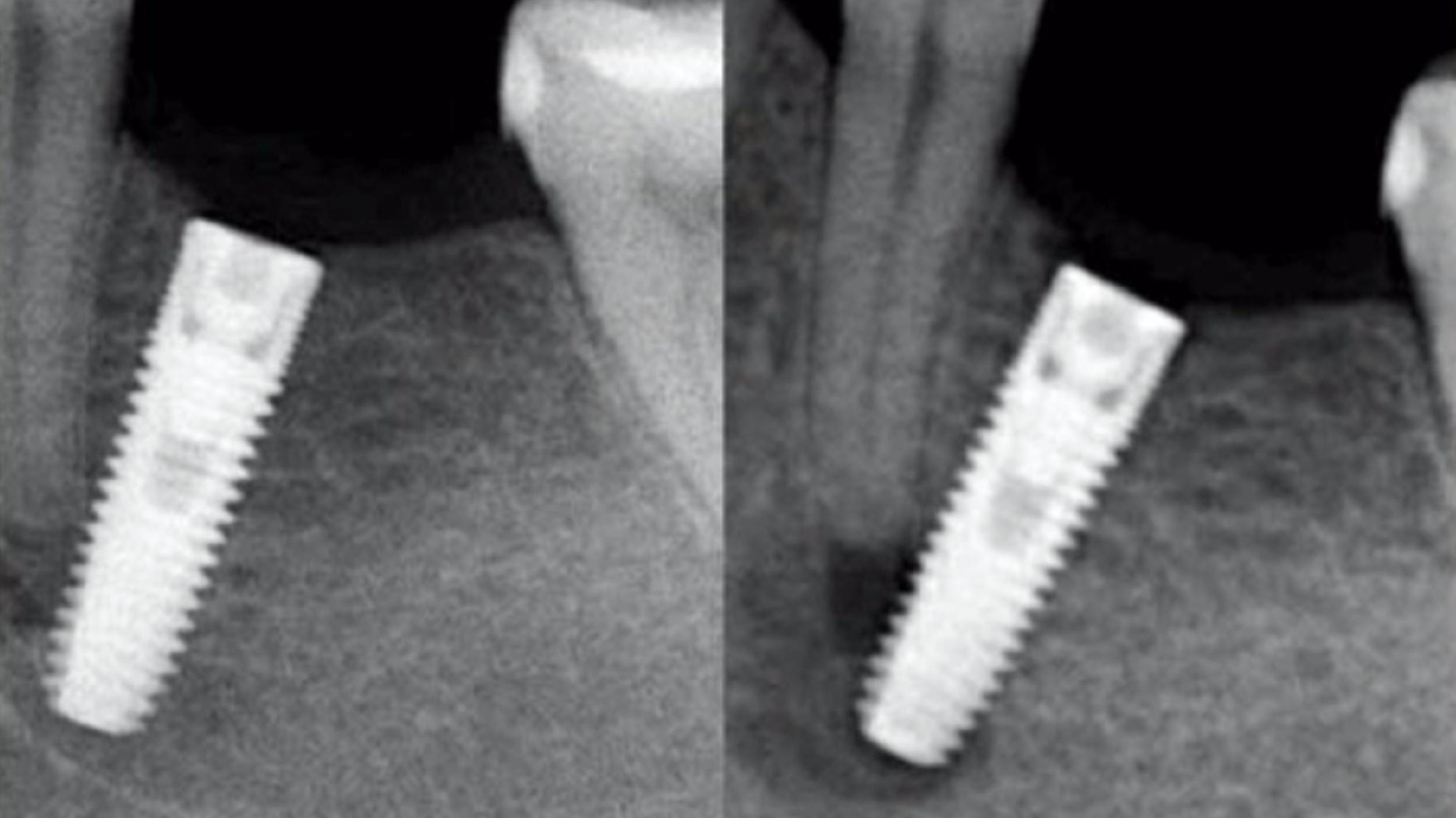 How to Reduce Pre, Peri, & Post-Operative Dental Implant Complications