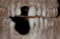 CLINICAL VIDEO Tissue and Bone Defect Restoration