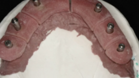 The All on 4 Concept: Diagnosis to Delivery Part 4 - Prosthetic Principles and