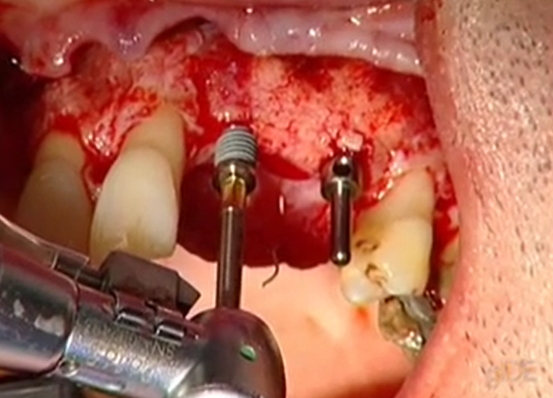 CLINICAL VIDEO Vertical Augmentation, membrane removal and implant placement | U